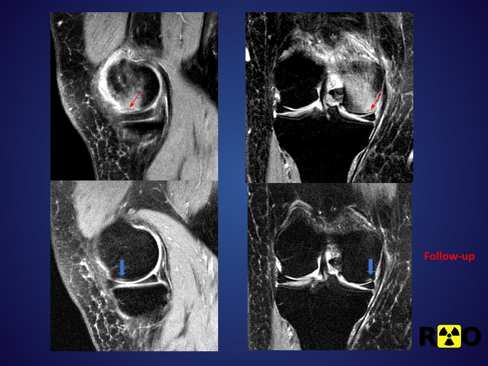 Come vediamo la frattura subcondrale del ginocchio Radiologia Ortopedica