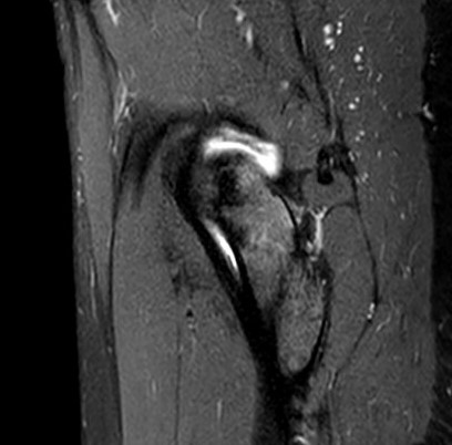 degenazione del labbro acetabolare