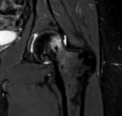 alterazione infiammatoria paramarginale indicativa per FAI