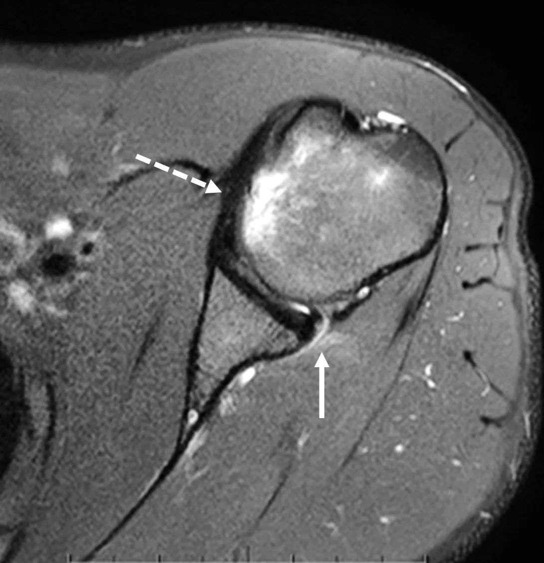  Le immagini assiali (2A e 2B) mostrano i riscontri di una lesione da instabilità gleno-omerale posteriore, tra cui lacerazione capsulo-labrale posteriore-posteroinferiore ed edema pericapsulare (frecce continue) e una lesione da impatto della testa omerale anteromediale (frecce tratteggiate).